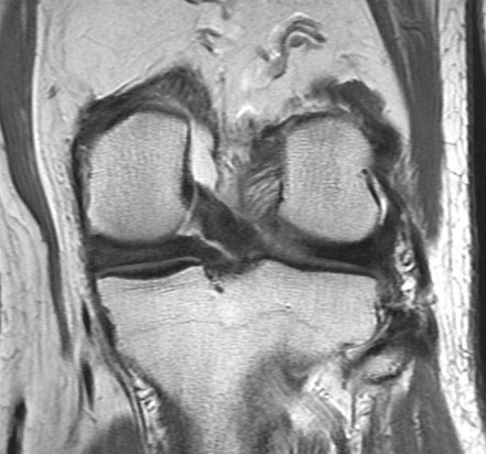 Figure 3 for case Root attachment tear of the posterior horn of the lateral meniscus (RID2763)